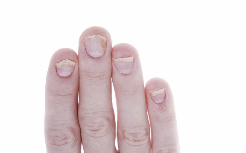 Nail Psoriasis 